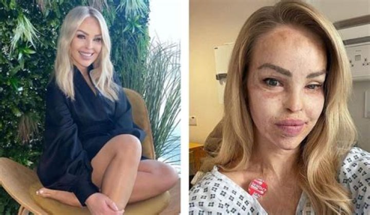 Katie Piper Biography, Age, Height, Husband, Net Worth, Family